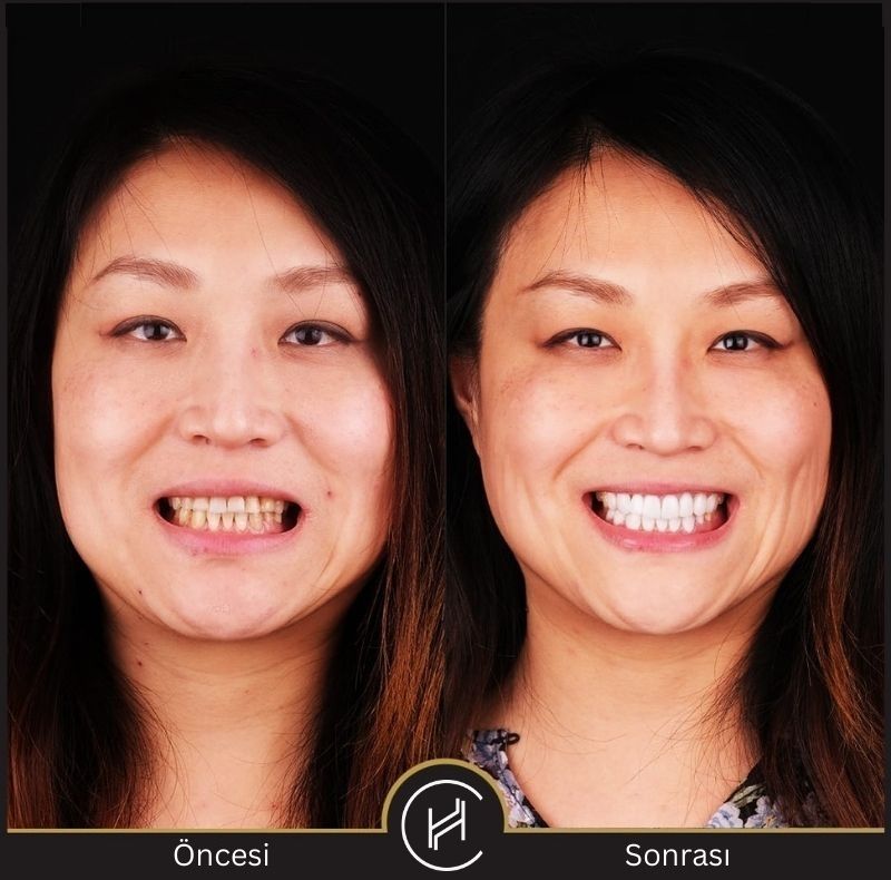 diş-kaplama-öncesi-ve-sonrası-fotoğrafı