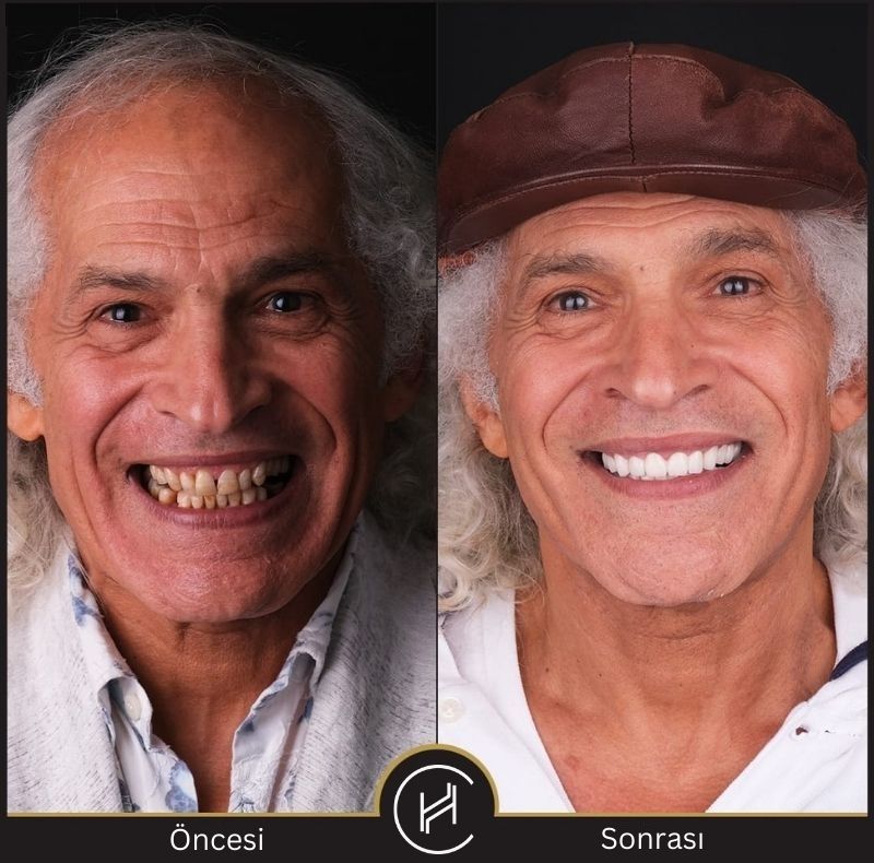 hollywood-gülümseme-diş-tedavi-erkek-önce-sonra