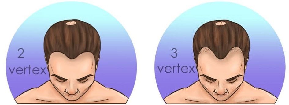 tepe-vertex-sac-dokulmesi-tipleri