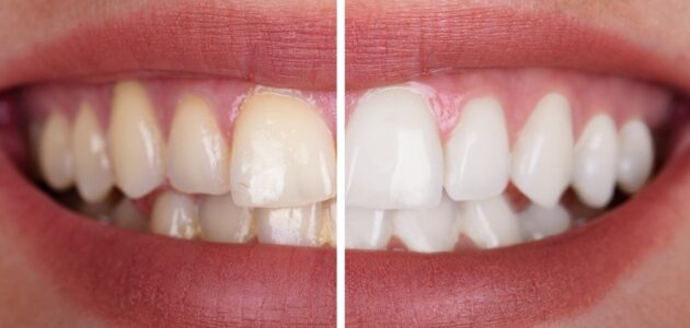 teeth whitening difference