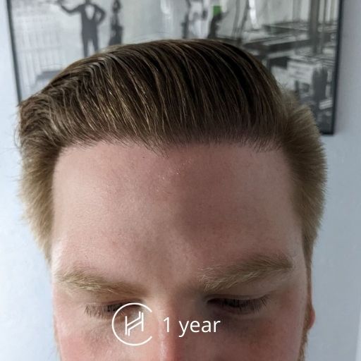 1 year after hair transplant front