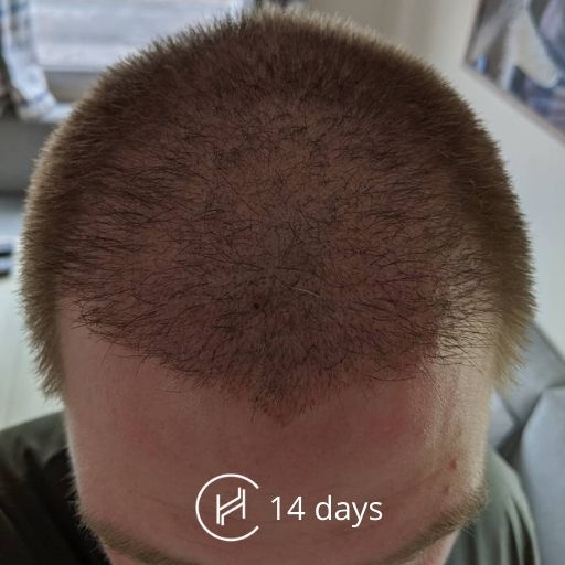 14 days after a hair transplant forehead