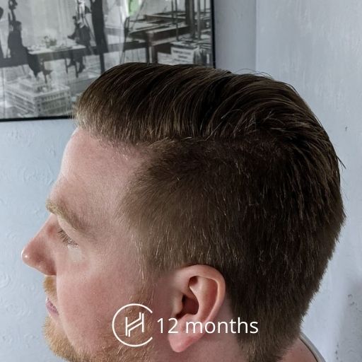 1 year after hair transplant side