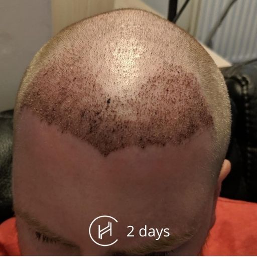 2 days after hair transplant forehead