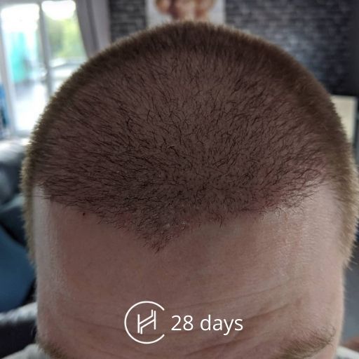 28 days after a hair transplant forehead