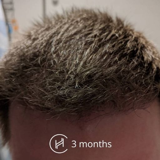 3 months after a hair transplant forehead