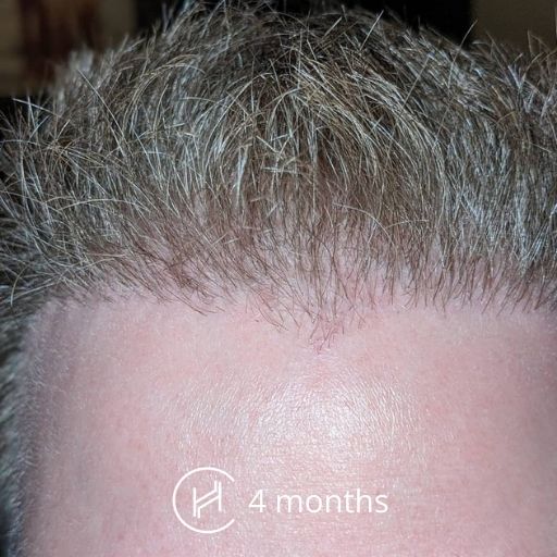 Hair Transplant Recovery Timeline  0  14 Months Photos