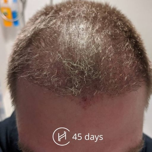 Hair Transplant Growth Timeline  Day By Day Recovery Photos