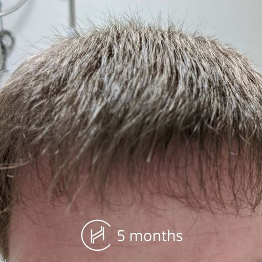 5 months after a hair transplant