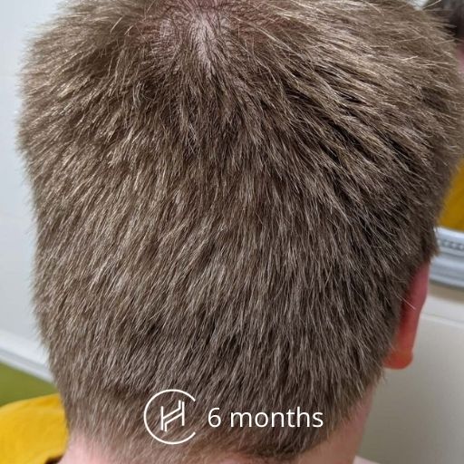 6 months after hair transplant donor area