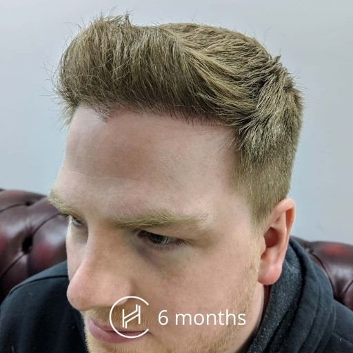 6 months after a hair transplant