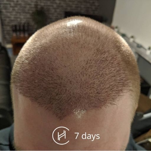 7 days after a hair transplant forehead