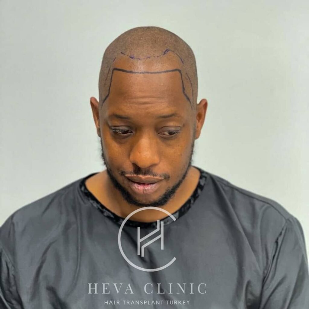 afro type hair black male hair transplant operation