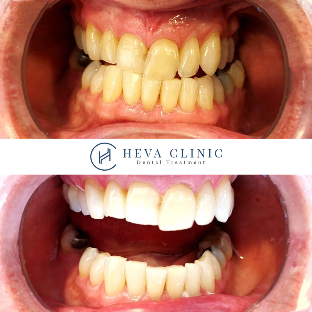 before after patient dental whitening heva clinic