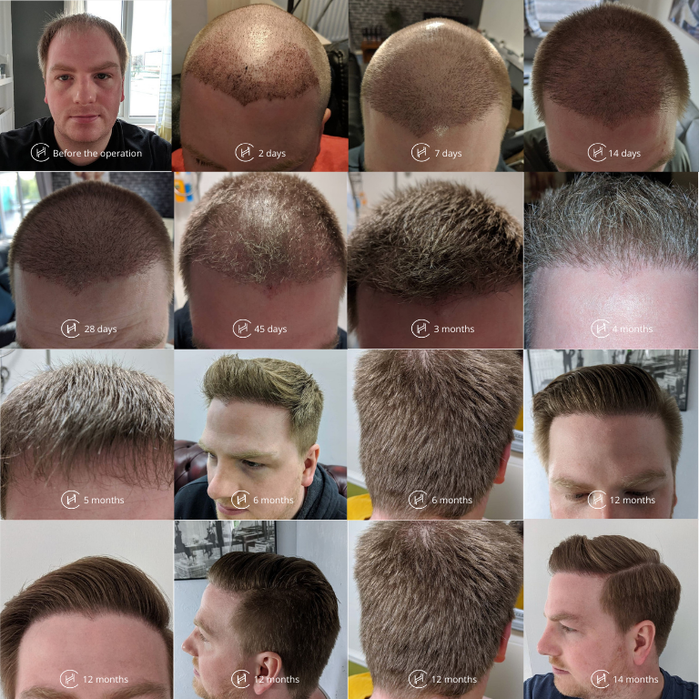 Hair transplant results after 5 months Over 5000 grafts