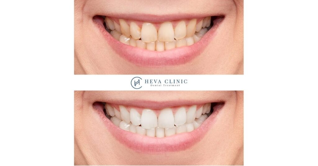 teeth whitening before and after heva clinic