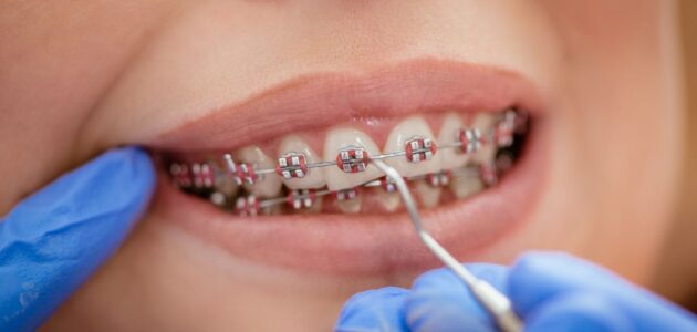 dental metal braces woman patient