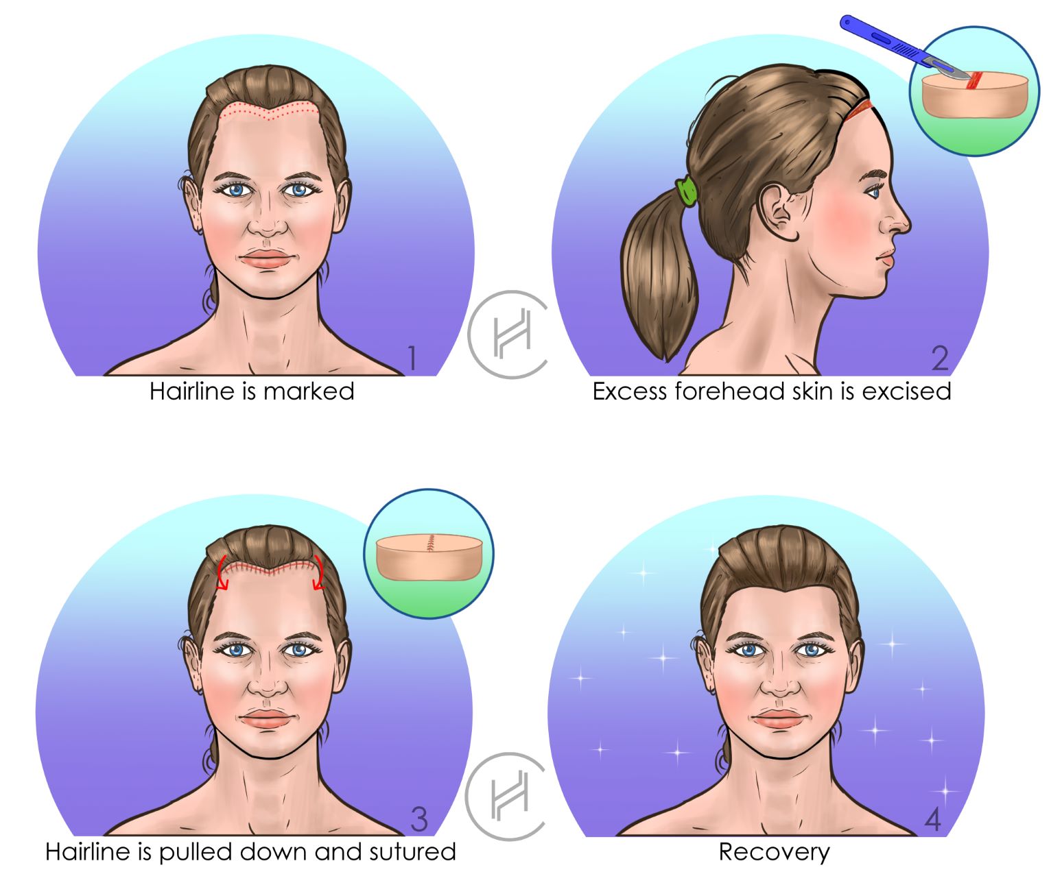 forehead reduction process steps forehead reduction hairline lowering procedure steps