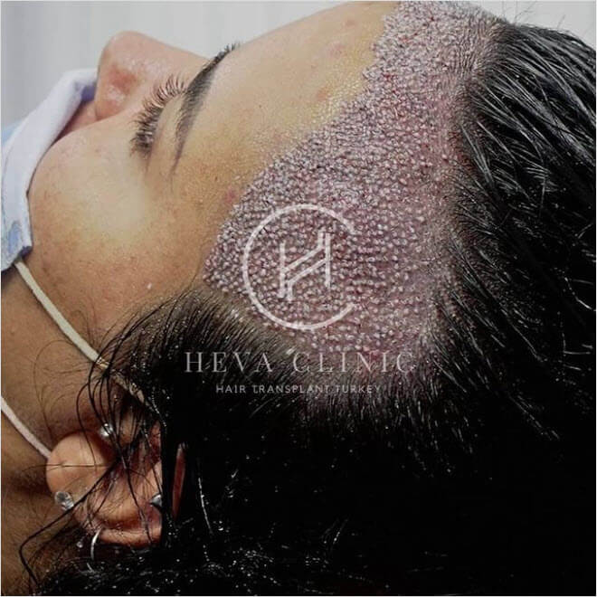 female hair transplant after operation