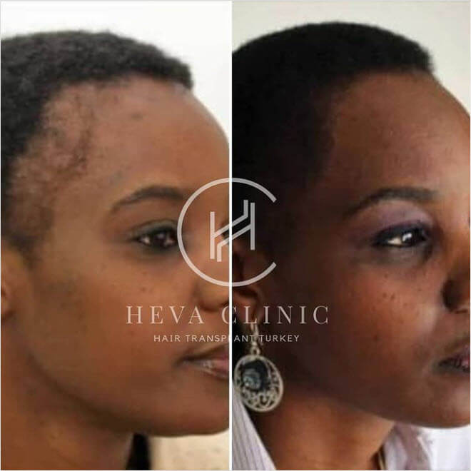 female afro hair transplant hairline before after