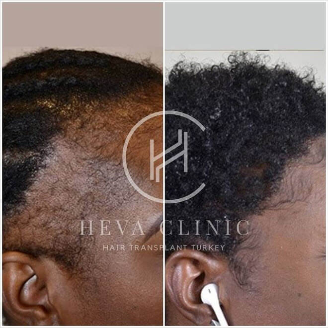 black female hairline restoration before after