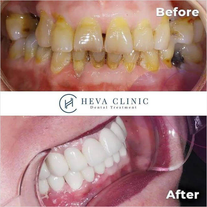 hollywood smile before after heva clinic dental