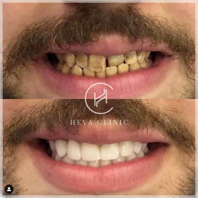 24 porcelain crowns before after heva clinic