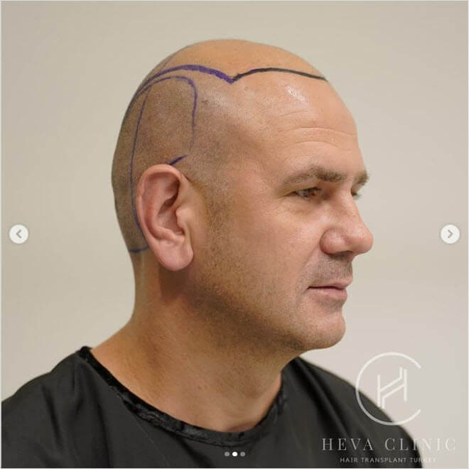 7000 Grafts Hair Transplant Turkey - Operation and Cost - Heva Clinic