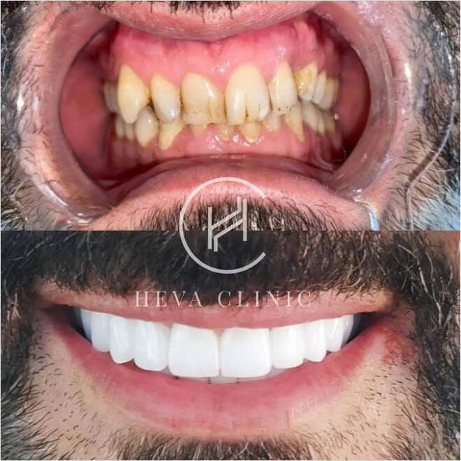 Hollywood Smile makeover made with 26 Zirconium Crowns before after