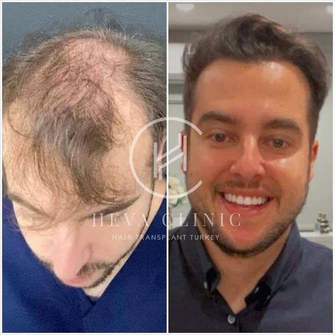 before after heva clinic patient 4500 graft hair transplant