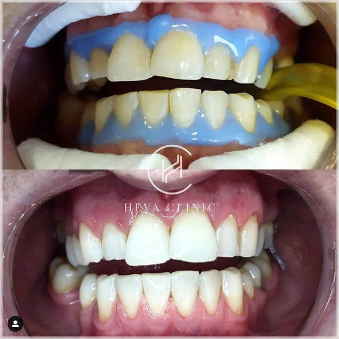 Laser Zoom teeth whitening before after