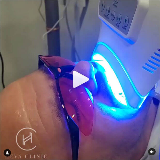 Laser Zoom teeth whitening in process video