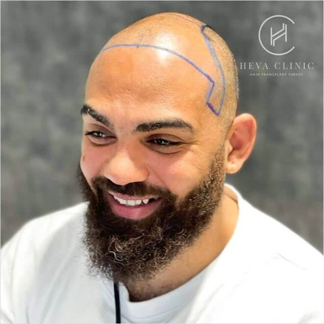 5000 plus graft hair transplant patient smiling heva clinic