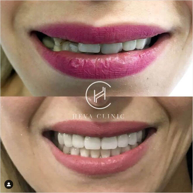 24 Zirconium Crowns before after female patient