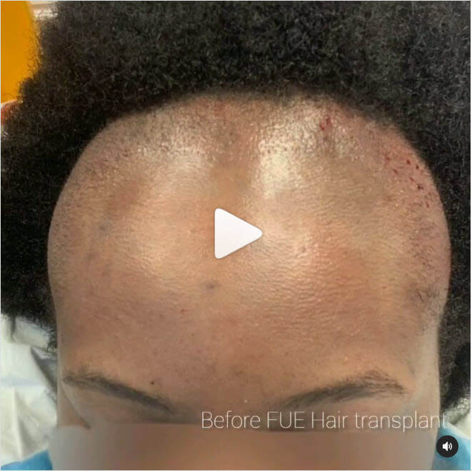 before hair transplant operation afro hair female