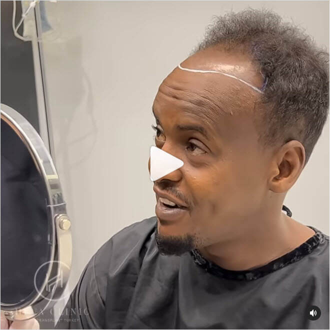 afro american patient hair transplant video