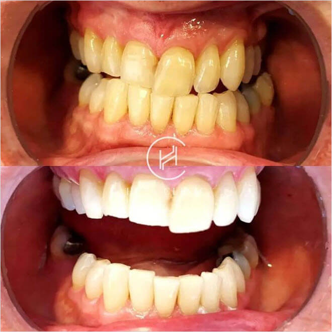 Laser Zoom teeth whitening before after dental