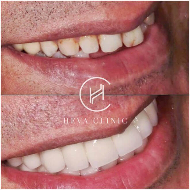 Full set of E-max veneers smile before after