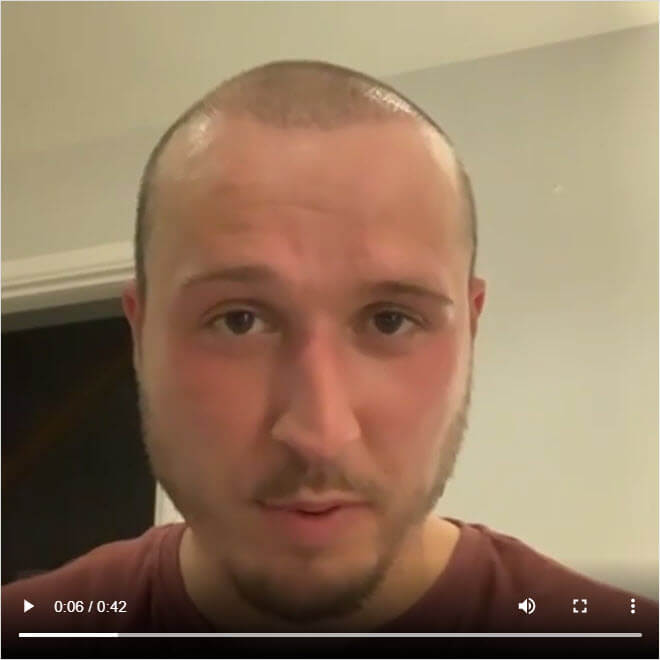 fue hair transplant heva clinic patient from the UK instagram