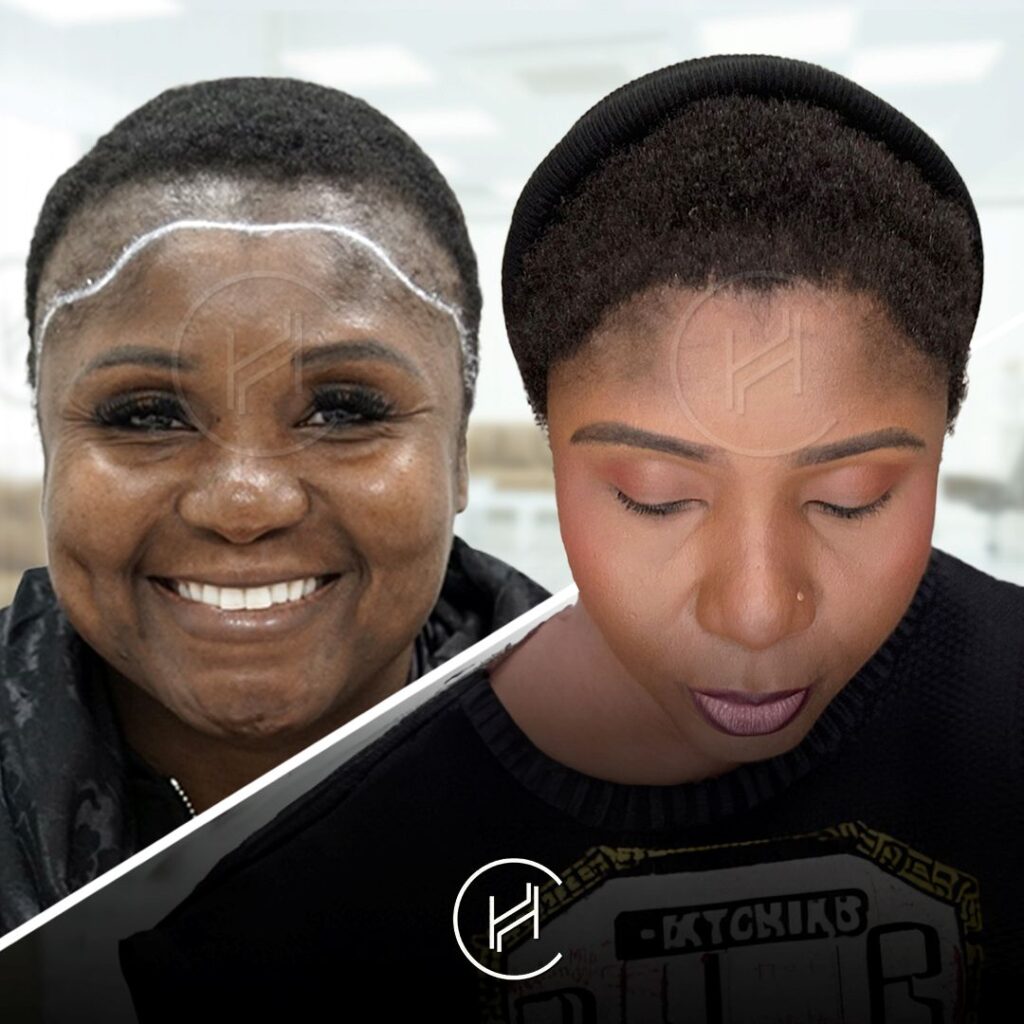 afro female hair transplant before and after results heva clinic