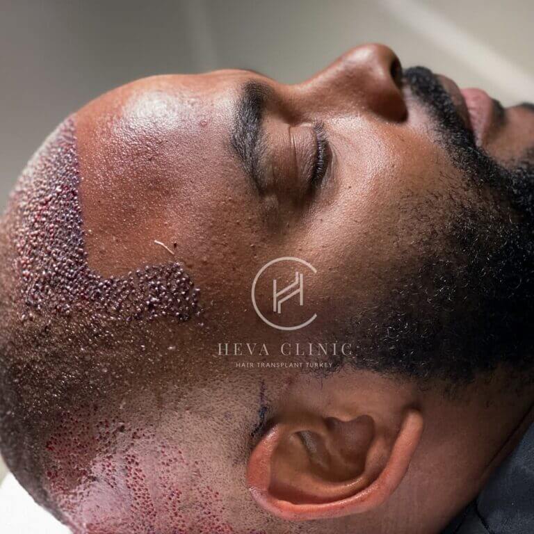 afro hair transplant patient after the operation at heva clinic