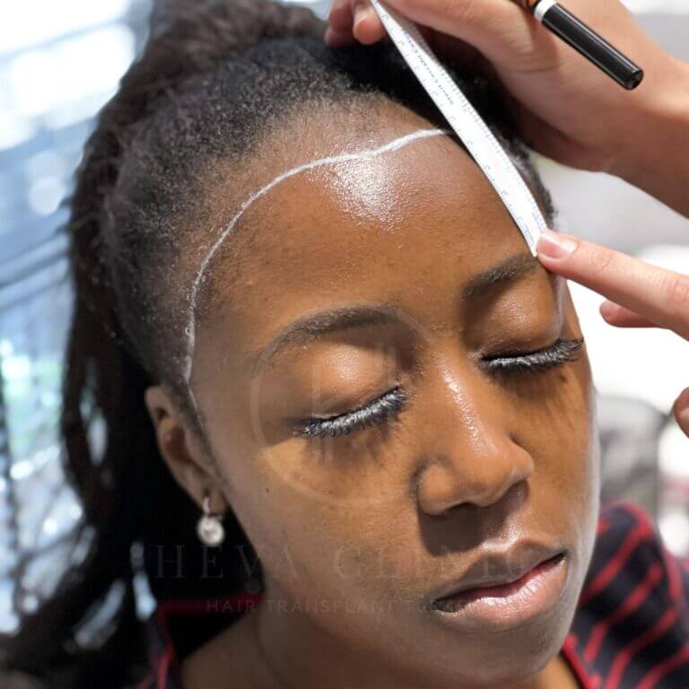 afro woman hair transplant hairline