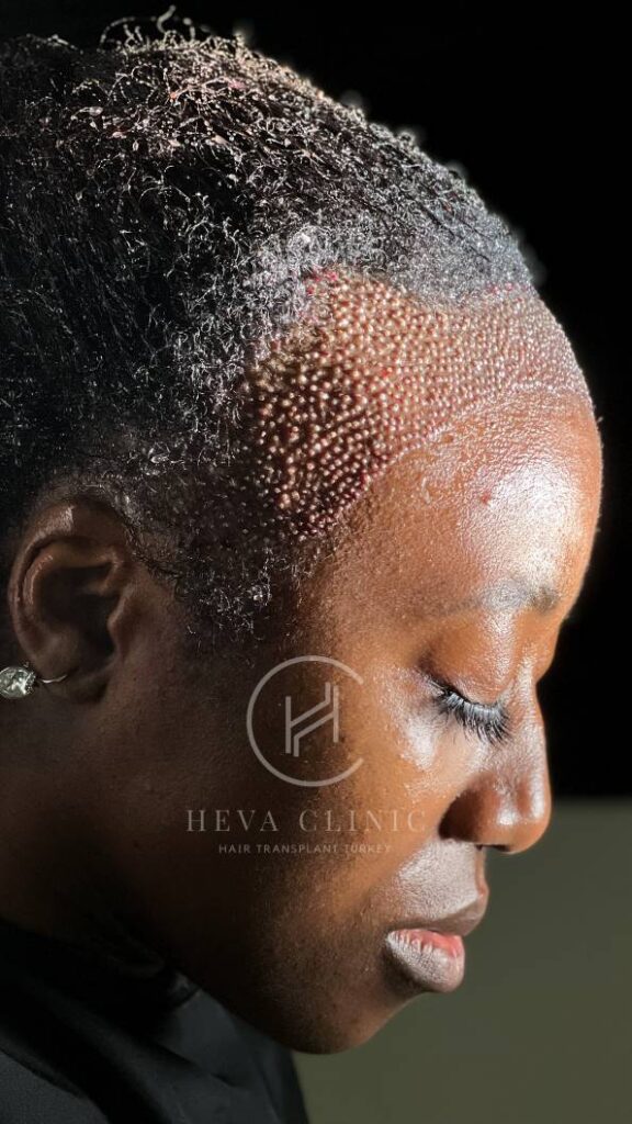 afro woman after hair transplant procedure