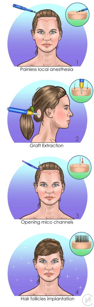 Female Hair Transplant in Turkey - Cost and Procedure - Heva Clinic Female Hair Transplant in Turkey - Cost and Procedure - Heva Clinic