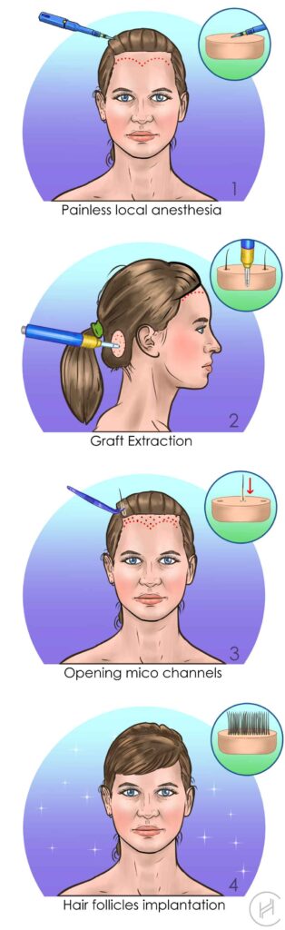 female fue hair transplant procedure step by step