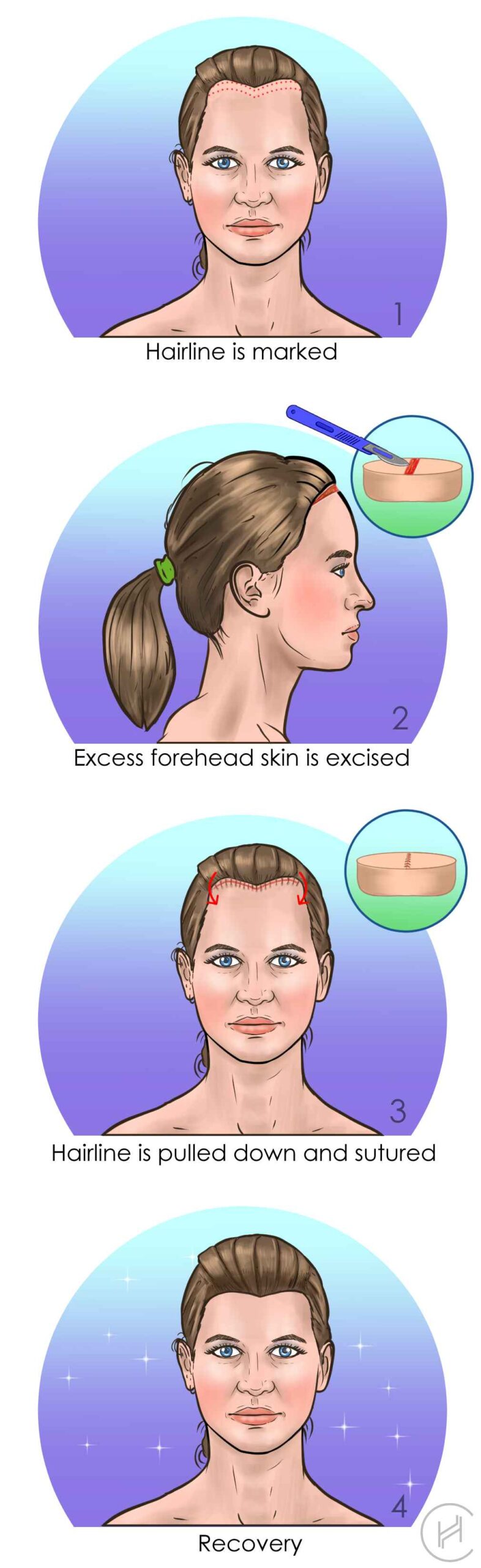 forehead reduction process steps forehead reduction hairline lowering procedure steps