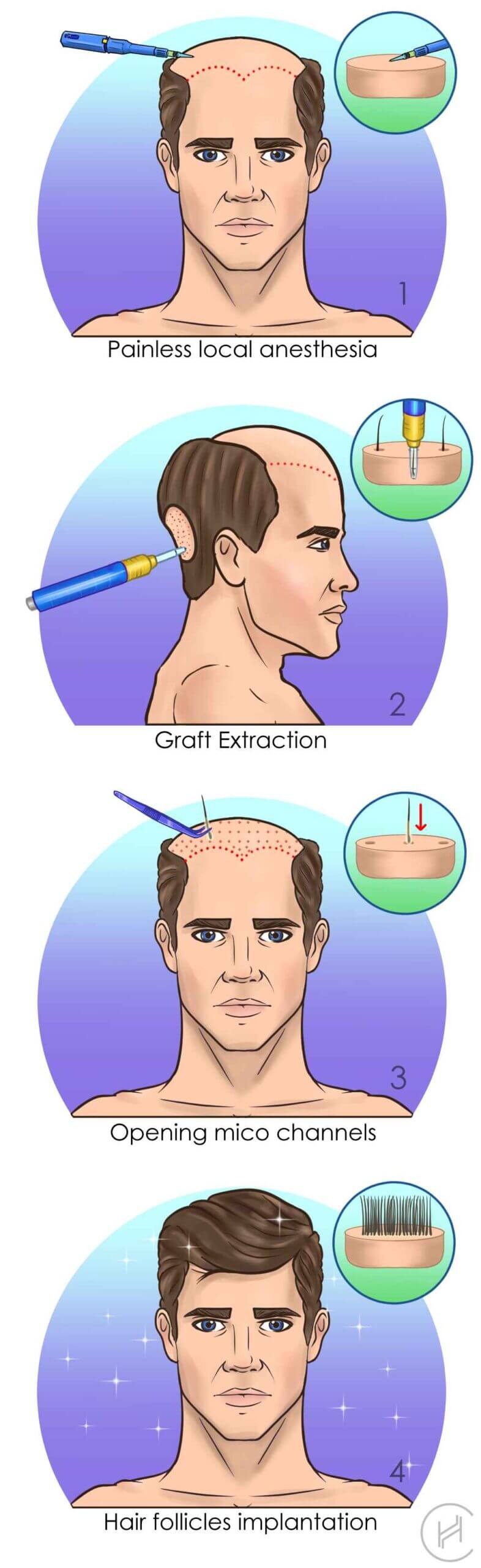 fue hair transplant process step by step
