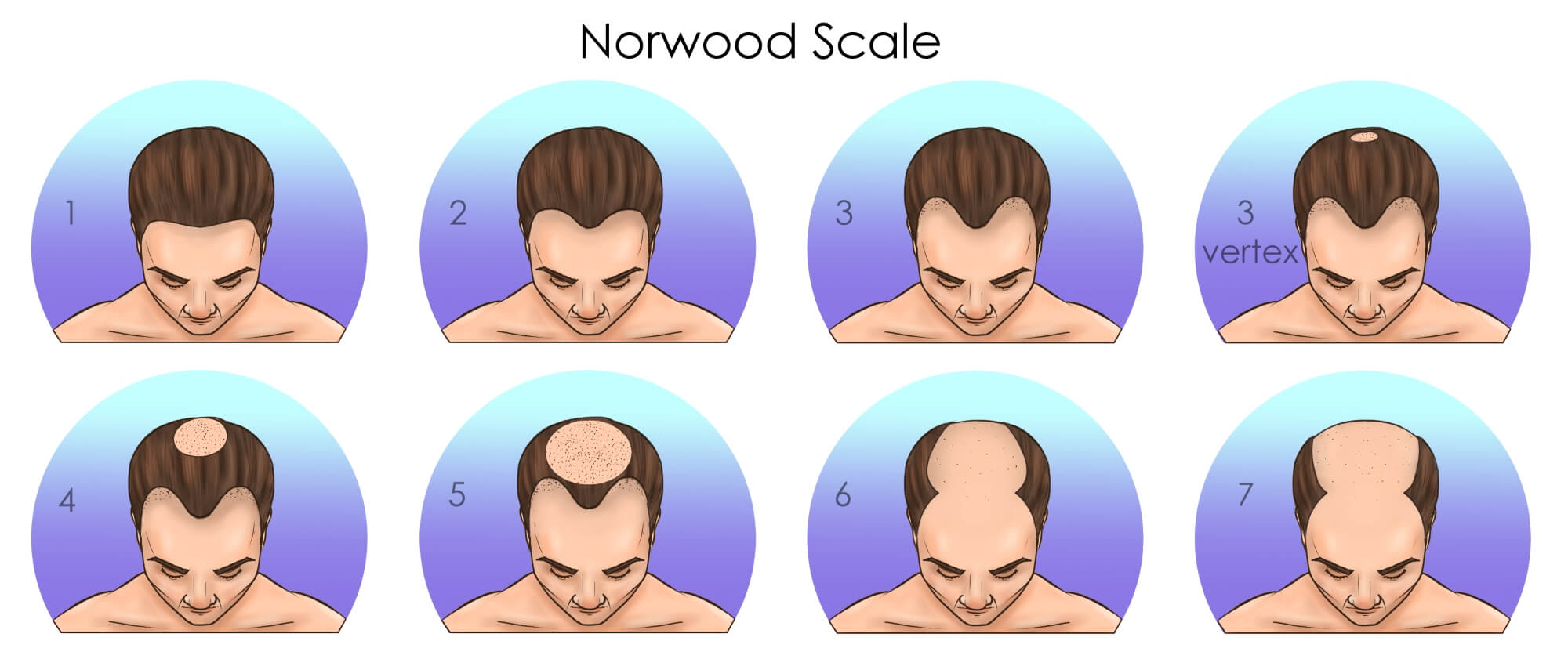 male type hair loss norwood scale