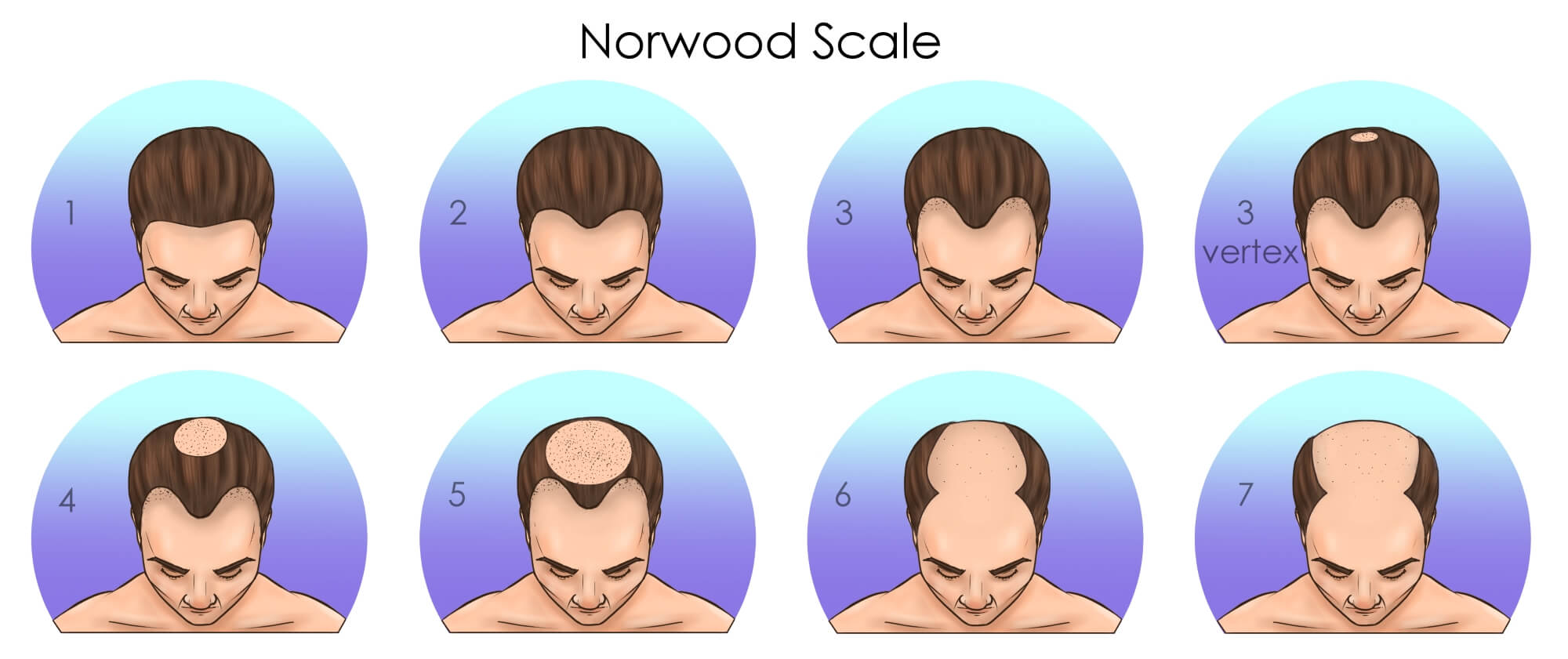 Norwood Stage 3 Photos Treatments Results  Wimpole Clinic