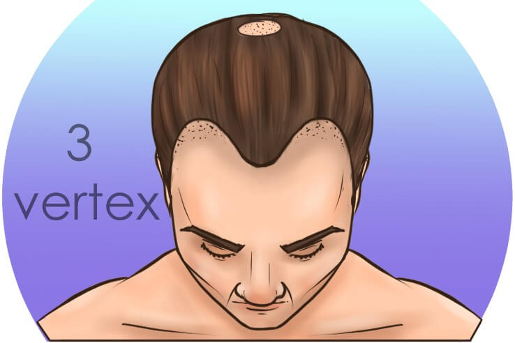 stage 3 vertex norwood hair loss scale